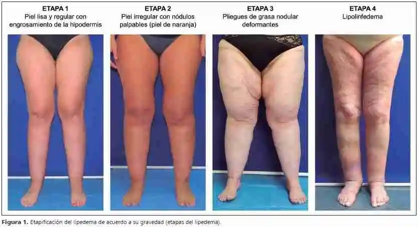 dieta-para-personas-con-lipedema-etapas 1